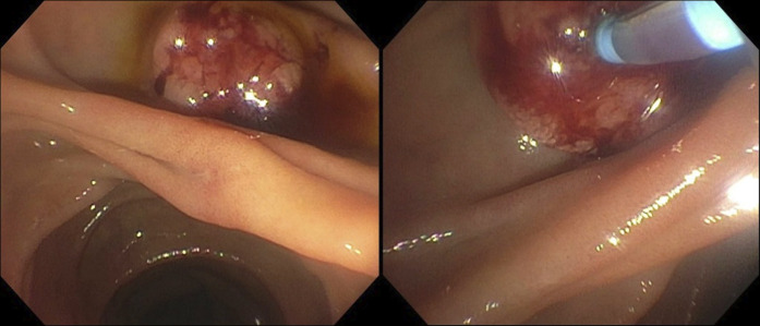 Biliary Radiofrequency Ablation and Sphincterotomy Restenosis: A Unique Case of Biliary Obstruction.