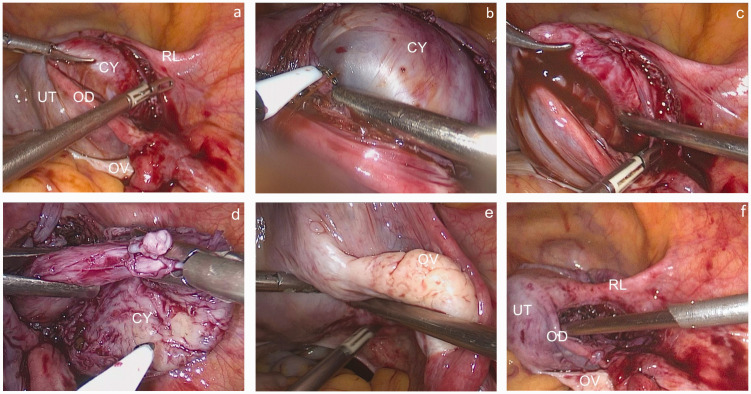 Accessory cavitated uterine malformation in a perimenopausal woman: Case report and literature review.