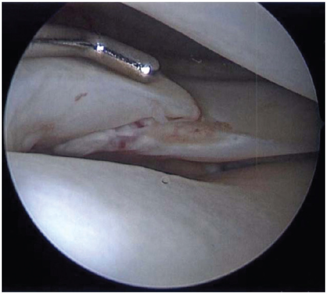 Evaluation of Outcomes at Mean 4.8 Years After Repair of Types 3 and 4 Lateral Meniscal Oblique Radial Tears during ACL Reconstruction.