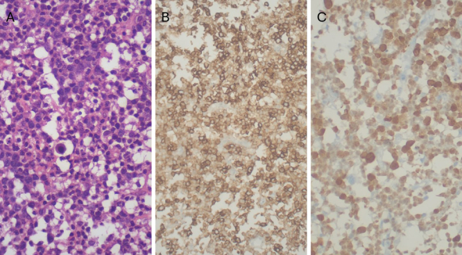 Anaplastic lymphoma kinase-positive primary CNS anaplastic large cell lymphoma in a pediatric patient: illustrative case.