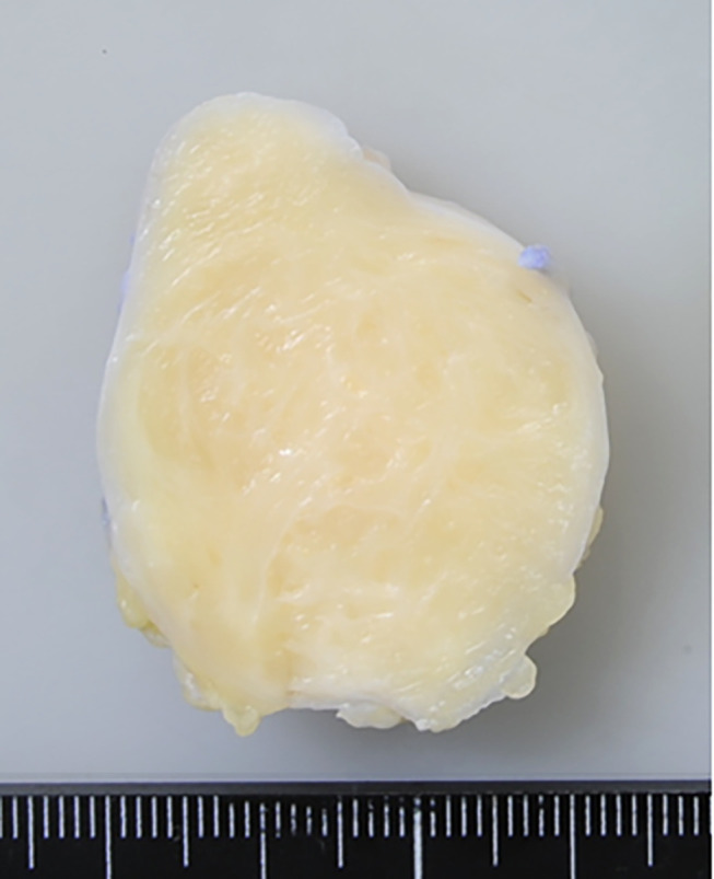 Lipofibromatosis Revisited.