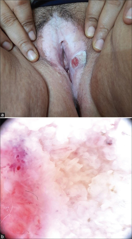 The Varying Faces of Vulvar Neoplasia.