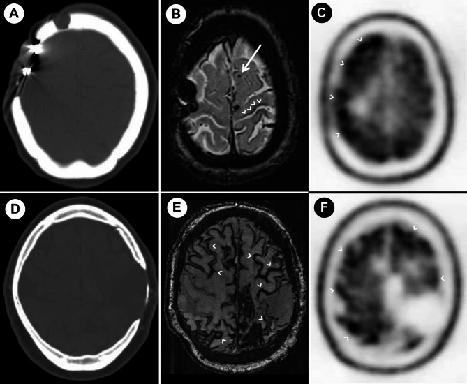Iatrogenic cerebral amyloid angiopathy: two new cases and systematic review of case reports with neuropathological data.