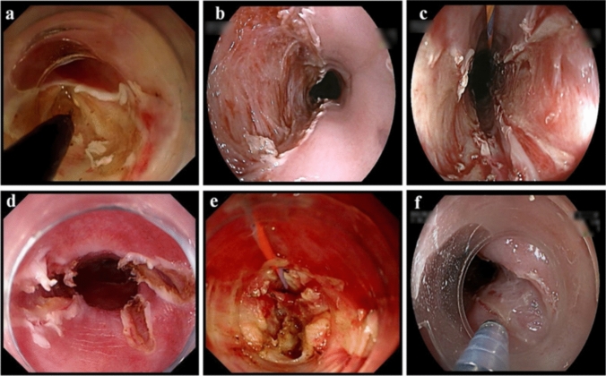 Long-Term Efficacy of Repeated Endoscopic Incision Combined with Triamcinolone Injection in Patients with Recurrent Benign Esophageal Stricture.