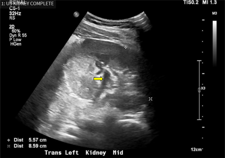 Novel WT1 and ACTN4 co-mutations in a patient with Denys-Drash syndrome and an atypical, potentially attenuated presentation of nephropathy: a case report.