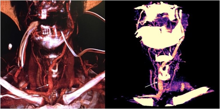 Ultrasound and Three-Dimensional Image Reconstruction Angio-Computed Tomography Scan for Hybrid Surgical Tracheostomy in Patient with Abnormal Neck Vascularization.