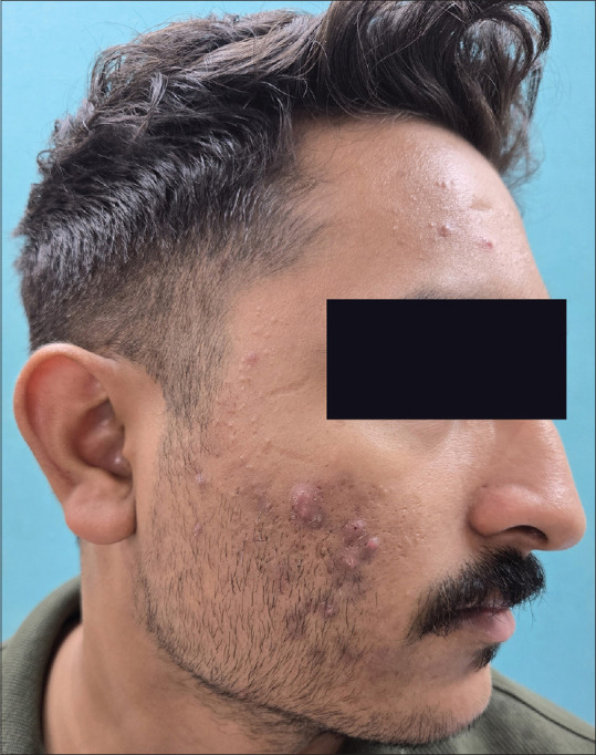 Exploring Trace Metal Imbalances: Serum Levels of Zinc, Selenium, Copper, Lead, Cadmium, and Mercury, and their Ratios in Acne Vulgaris Patients: An Analytical Cross-sectional Study.