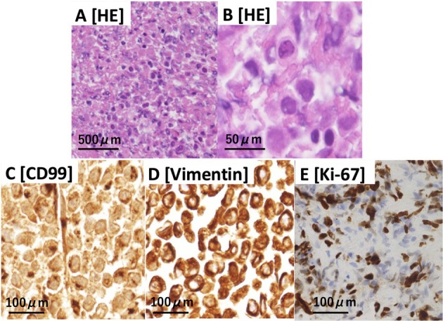 Anaplastic Lymphoma Kinase-Rearranged Chest Wall-Undifferentiated Small Round Cell Sarcoma With Massive Pleural Effusion and Rapid Progression: A Case With Autopsy Report.