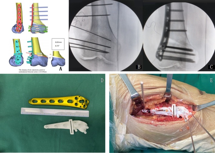 Analysis of Intraoperative and Postoperative Hinge Fractures of Patients With Genu Valgum Treated With Lateral Open Wedge Distal Femoral Osteotomy.