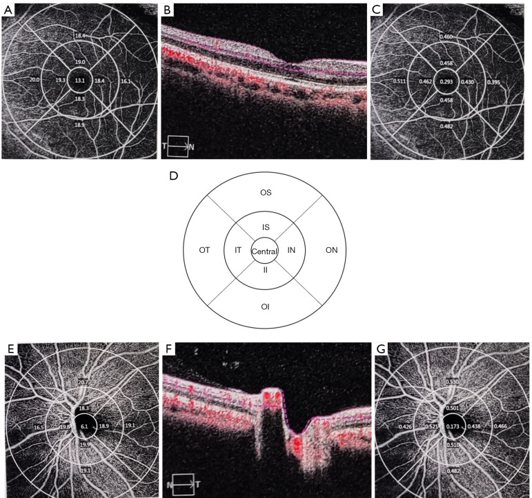 Quantitative analysis of macular and optic disc microvascular parameters in patients with immunoglobulin A nephropathy using optical coherence tomography angiography.
