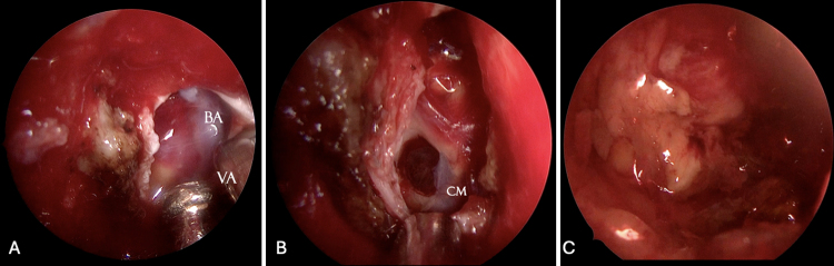 Endoscopic endonasal transclival approach for the resection of a ventral pontine cavernous malformation: illustrative case.