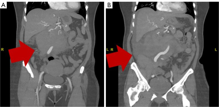 Unveiling the unexpected: spontaneous ruptured pancreaticoduodenal artery pseudoaneurysm with retroperitoneal hematoma requiring pancreaticoduodenectomy.