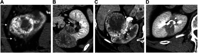 Accuracy of Contrast-enhanced CT in Diagnosing Small-sized cT3a Renal Cell Carcinoma and Analysis of Factors Predicting Downstaging to pT1.