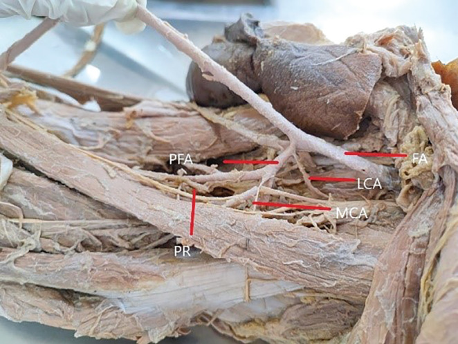 Unveiling the secrets of the profunda femoris artery: A cadaveric journey with morphometric insights.