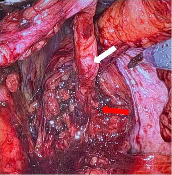 Combined robot-assisted surgery of upper and lower genitourinary tract with excellent early functional and oncological outcome - a case report of a concomitant nerve-sparing radical prostatectomy, diverticulectomy and ureterectomy.