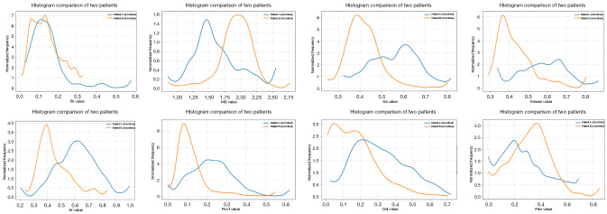 Added prognostic value of histogram features from preoperative multi-modal diffusion MRI in predicting Ki-67 proliferation for adult-type diffuse gliomas.