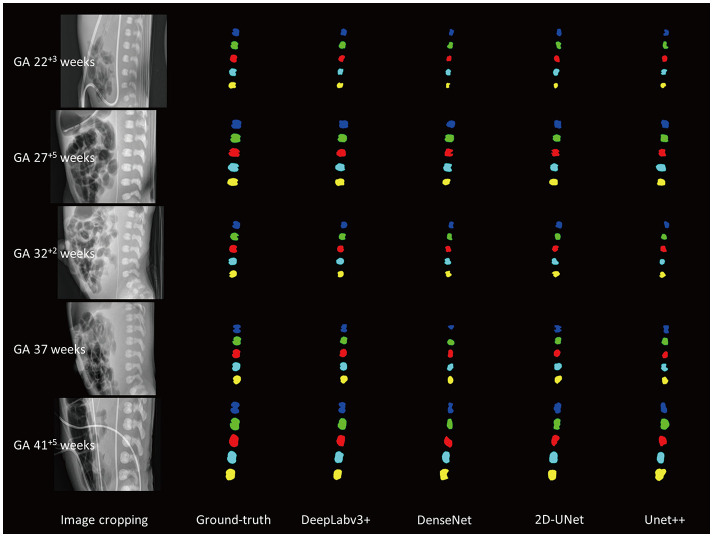 Development of a Deep-Learning Model for Estimating Newborn Gestational Age via Lumbar Vertebral Segmentation on Plain Radiography.