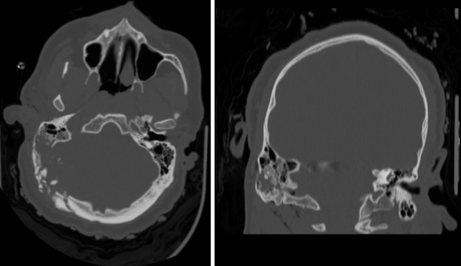 Upfront use of temporal myofascial flap for repair of traumatic injury and prevention of CSF leaks: illustrative cases.