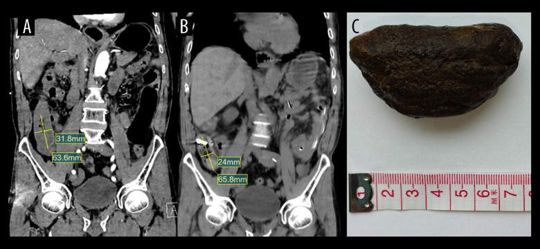Non-Surgical Resolution of Phytobezoar-Induced Bowel Obstruction Using Sodium Bicarbonate and Catheter: A Report of 2 Cases.