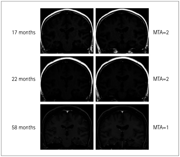 Brain Atrophy Can Predict the Severity and Prognosis of Anti-N-Methyl-D-Aspartate Receptor Encephalitis.