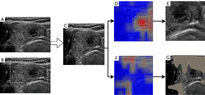 Combining curriculum learning and weakly supervised attention for enhanced thyroid nodule assessment in ultrasound imaging.