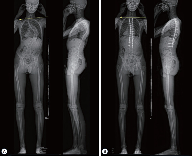 Surgical Correction for Adolescent Idiopathic Scoliosis : A Case Series of 139 Consecutive Patients Treated in Neurosurgical Department.