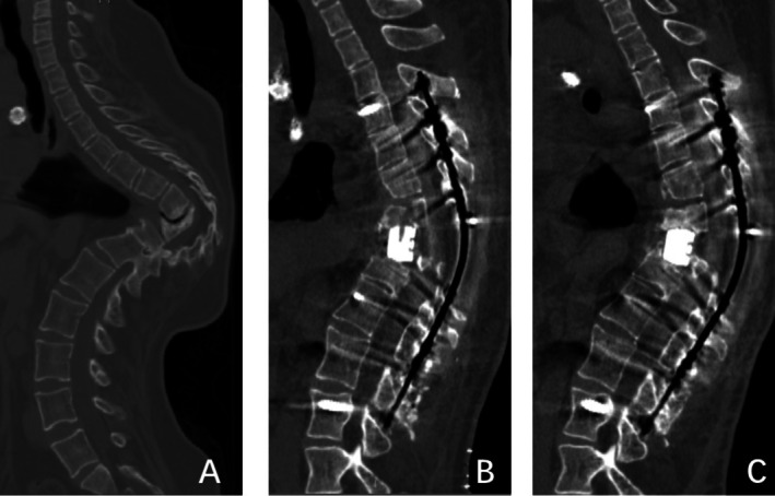 Risk Factors for Poor Matching of Intervertebral Fusion Devices After Posterior Vertebral Column Resection in Patients With Kyphosis or Kyphoscoliosis.