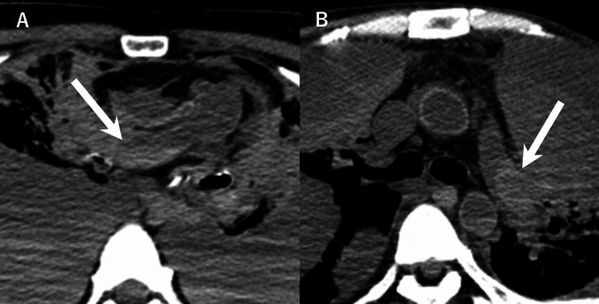 Postmortem computed tomography assessment of intracardiac and intravascular blood clots and gravitational sedimentation: clinical and laboratory associations in 114 in-hospital deaths.