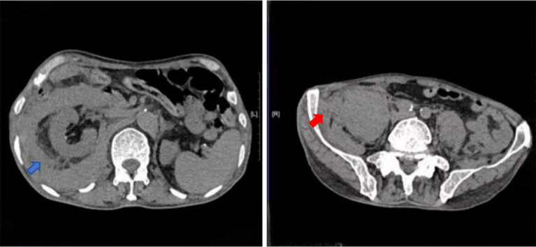 Transcatheter arterial embolization for retroperitoneal bleeding in patients with lumbar artery injury and essential thrombocythemia: a case description.