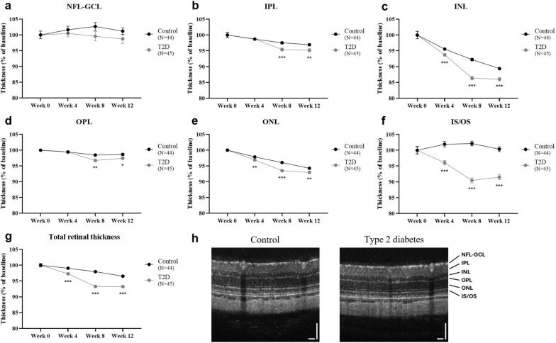 Early retinal changes in type 2 diabetes detected by texture-based OCT analysis: potential approach for subclinical diabetic retinopathy diagnosis.