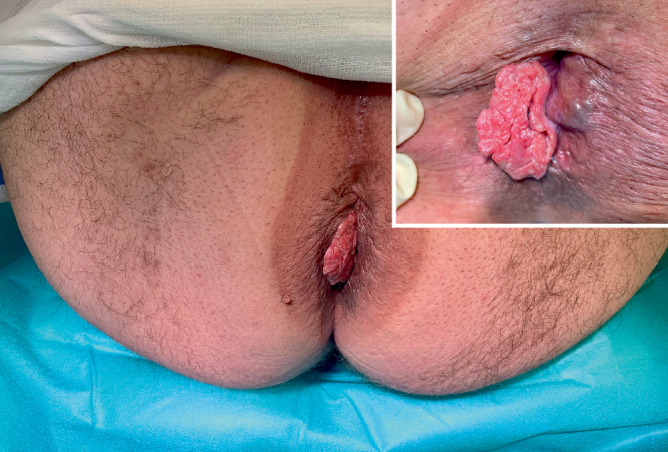 [Anal cancer-Interaction between outpatient and inpatient treatment].