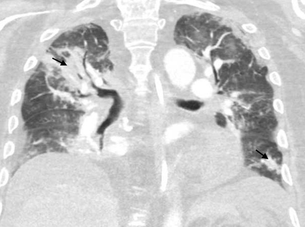 Severe Disseminated Adenovirus Infection After Haploidentical Hematopoietic Stem Cell Transplantation: A Case Report.