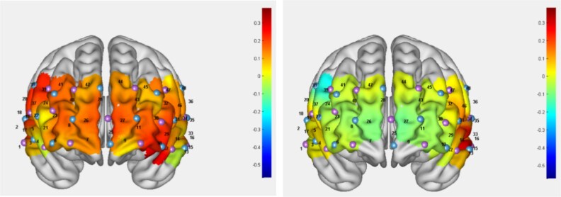 Distinct neural activation patterns in executive functions of schizophrenia patients with predominant positive and negative symptoms: an fNIRS study.