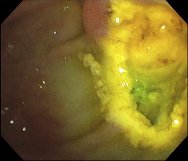 Biliary Radiofrequency Ablation and Sphincterotomy Restenosis: A Unique Case of Biliary Obstruction.