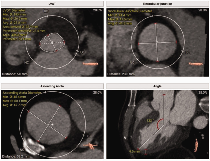 Transcatheter aortic valve implantation in a patient with isolated aortic regurgitation using JenaValve.