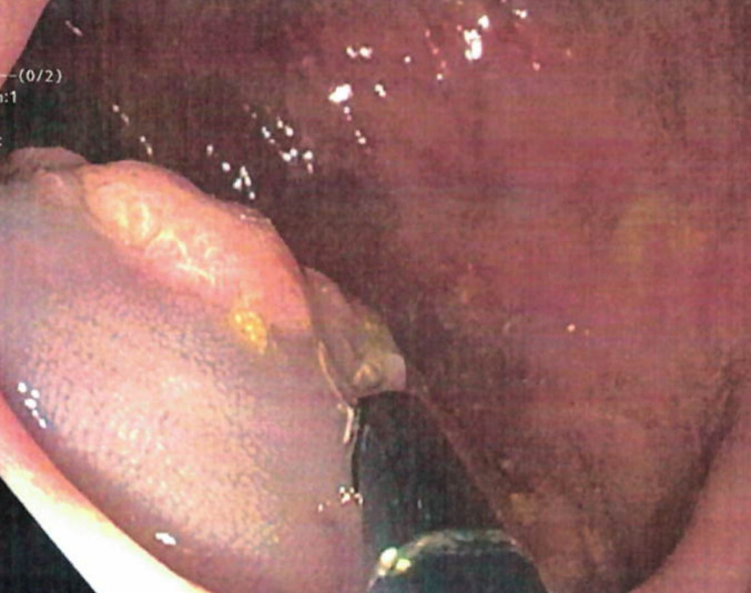 A novel insertion/deletion in APC promotor 1B is associated with both gastric and colon polyposis.