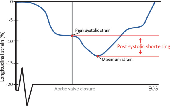 Pathological post-systolic shortening as a prognostic marker for major cardiovascular events in patients with type 2 diabetes.