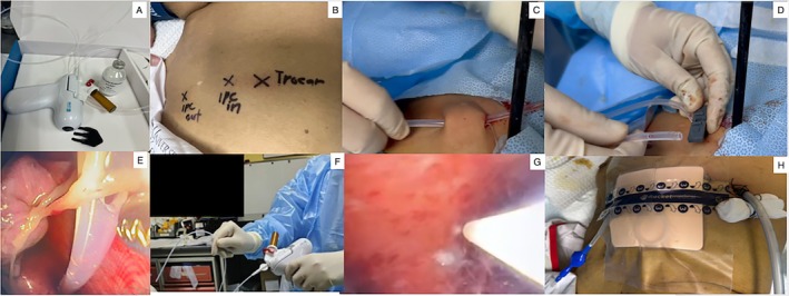 Synergistic Sealing of the Pleural Space: Combining Thoracoscopic Talc Poudrage and IPC for Malignant Pleural Effusion-A Case Series.