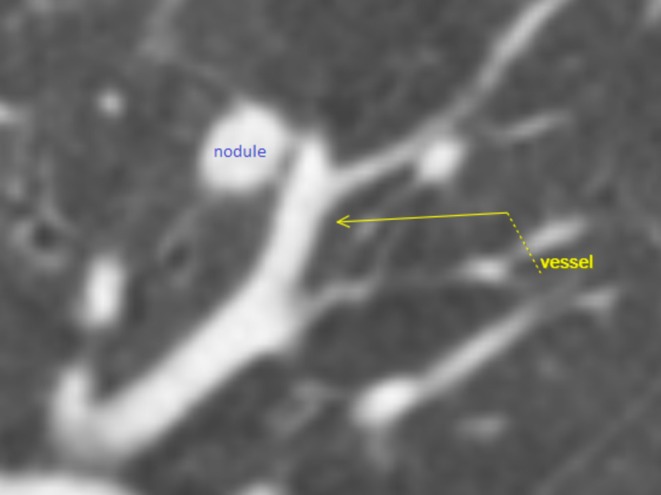 AIM (Anticipate/Adjust, Image, Manage) to Prevent Bleeding During Robotically-Assisted Bronchoscopic Ablation.