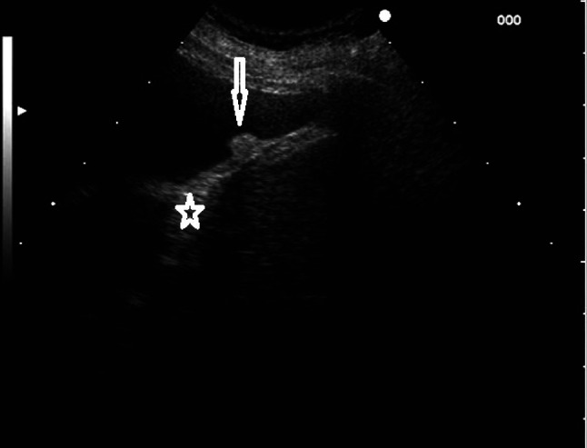 A Diagnostic Approach to Malignant Pleural Mesothelioma.