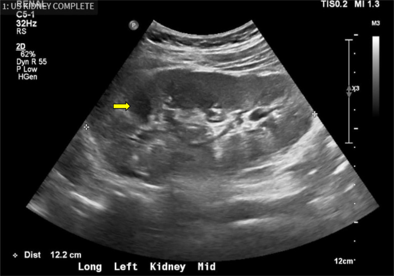 Novel WT1 and ACTN4 co-mutations in a patient with Denys-Drash syndrome and an atypical, potentially attenuated presentation of nephropathy: a case report.