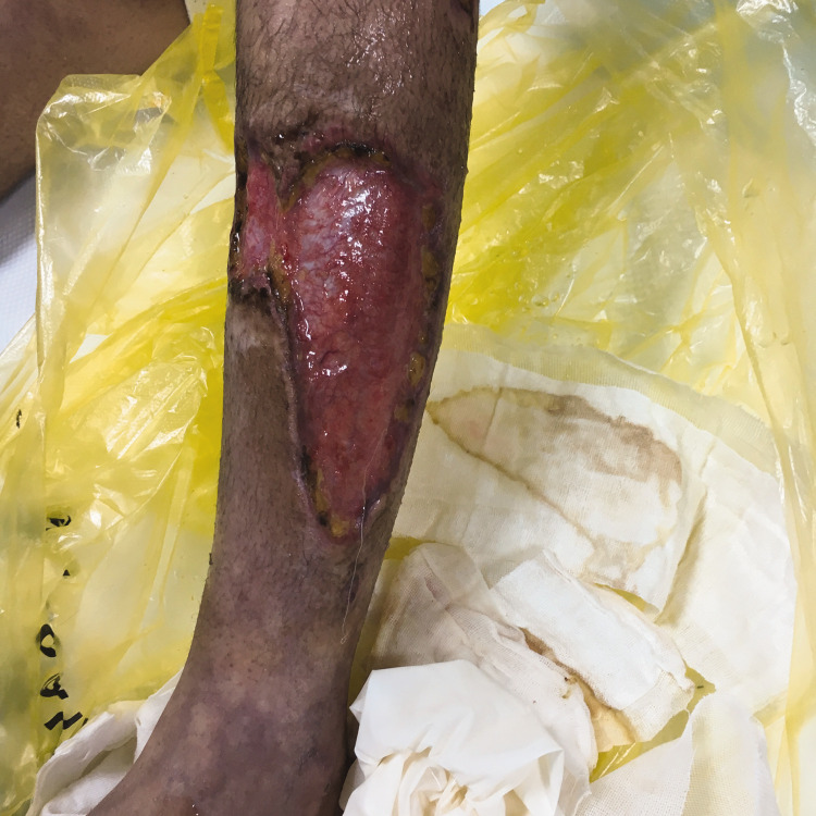 Recurrent single-organ cutaneous small-vessel vasculitis with streptococcal infection in a pediatric patient: A case report.