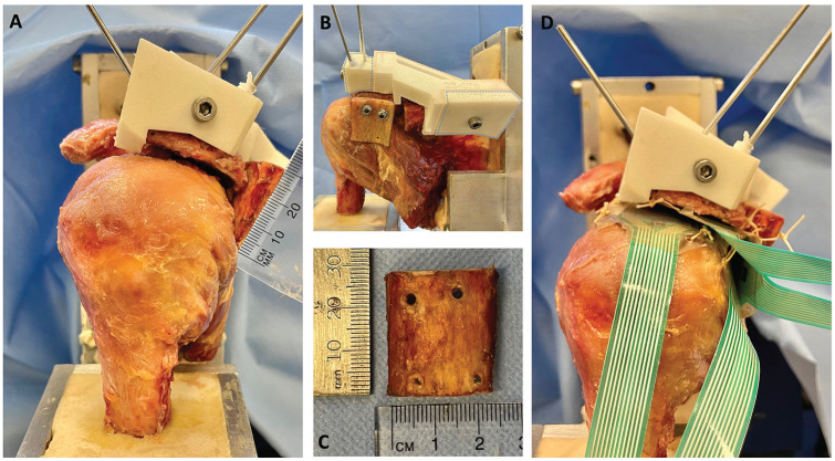 Posterior Shoulder Stability Can Be Restored by Posterior Acromial Bone Grafting (Scapinelli) in a Cadaveric Biomechanical Model With Normal Glenoid Anatomy.