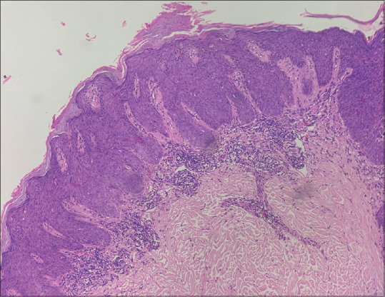 Dermoscopy and Ultraviolet Reflectance Dermoscopy of Benign Lichenoid Keratosis Masquerading as Melanoma.
