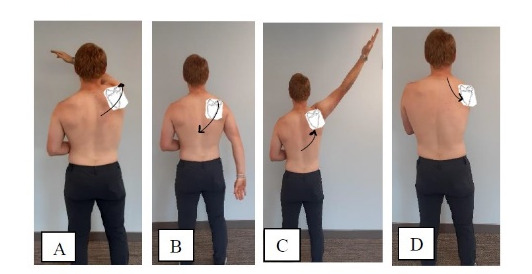 Proprioceptive Neuromuscular Facilitation for the Upper Extremity and Scapula: Review and Update on Rehabilitation of Shoulder Pathology.
