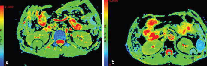 Diffusion kurtosis versus diffusion-weighted magnetic resonance imaging in differentiating clear cell renal cell carcinoma and renal angiomyolipoma with minimal fat: a comparative study.