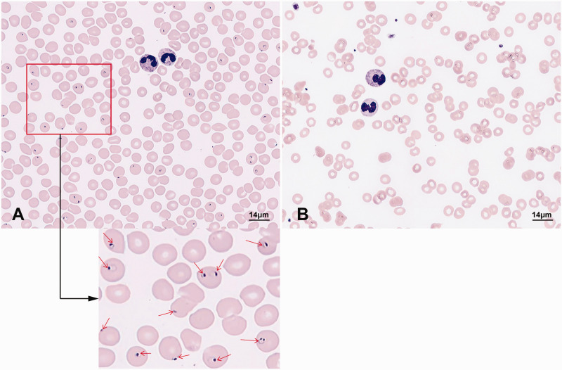 A fatal case report of <i>Plasmodium falciparum</i> malaria complicated by acute subdural hematoma.