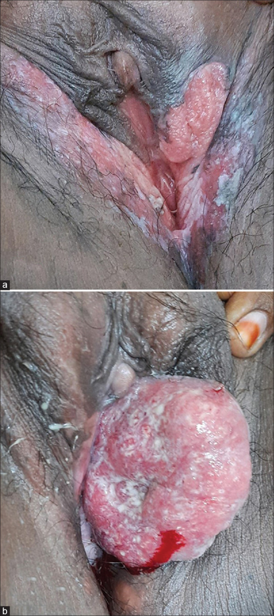 The Varying Faces of Vulvar Neoplasia.