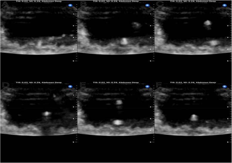 A novel protocol for the characterization of ureteral stent echogenicity.