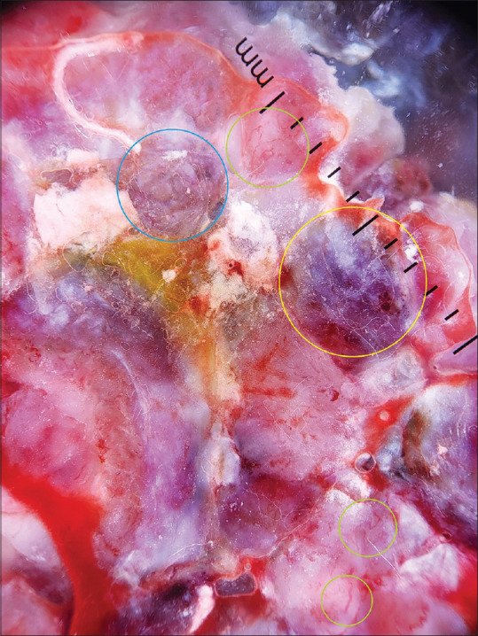 Nodular Melanoma.
